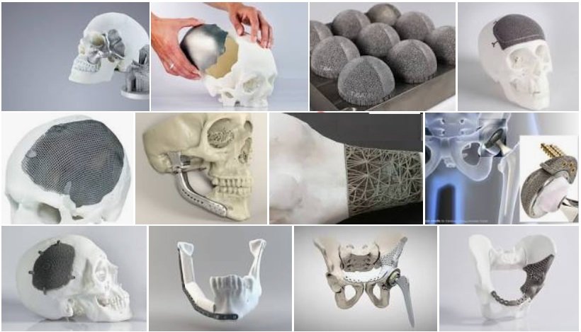 implants Нові технології створення кісткових імплантів