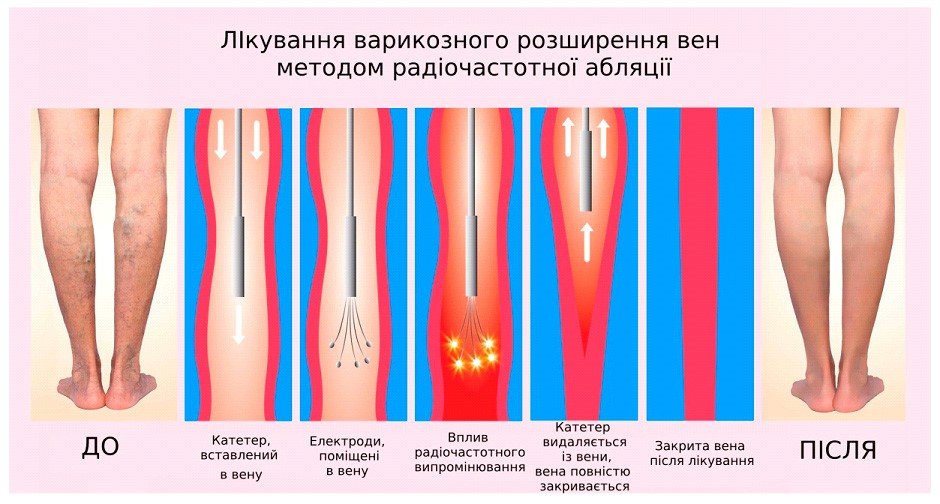 Сучасне лікування варикозного розширення вен нижніх кінцівок Сучасне лікування варикозного розширення вен нижніх кінцівок