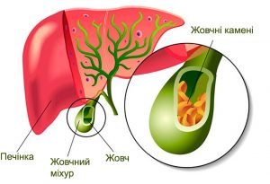 Що треба знати про жовчно-кам′яну хворобу Що треба знати про жовчно-кам′яну хворобу