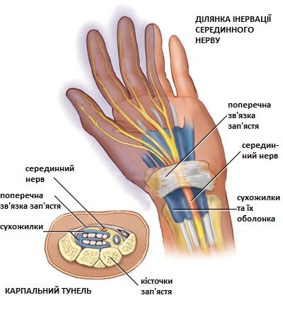 Синдром карпального каналу (СКК) Синдром карпального каналу (СКК)