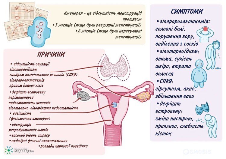 Аменорея: сучасний погляд на проблему Аменорея: сучасний погляд на проблему